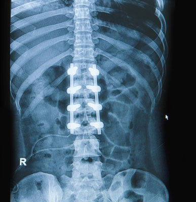 spinal-fusion-treatment-img